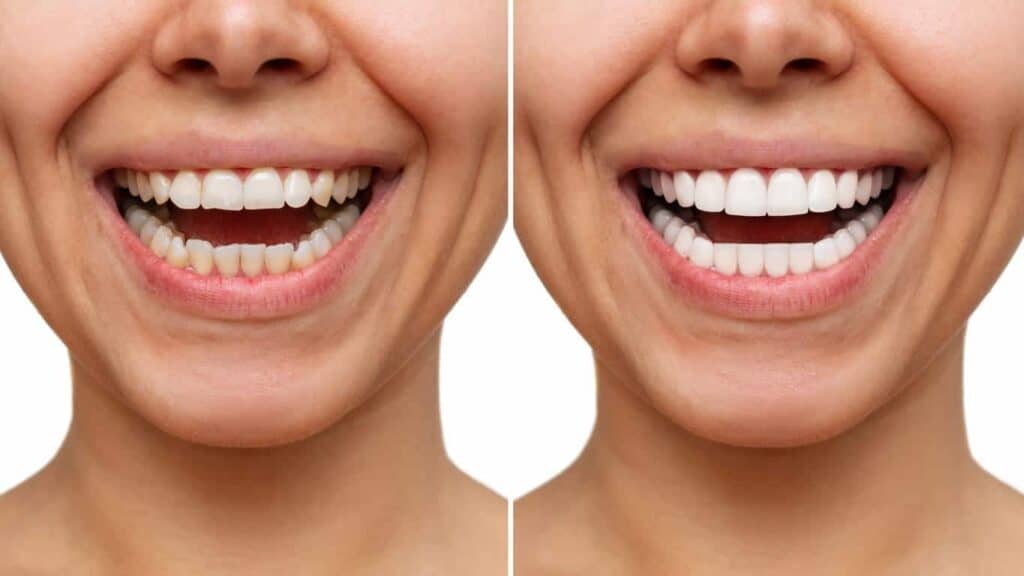 Contact Aspire White for teeth whitening services – Get in touch with Hastings today