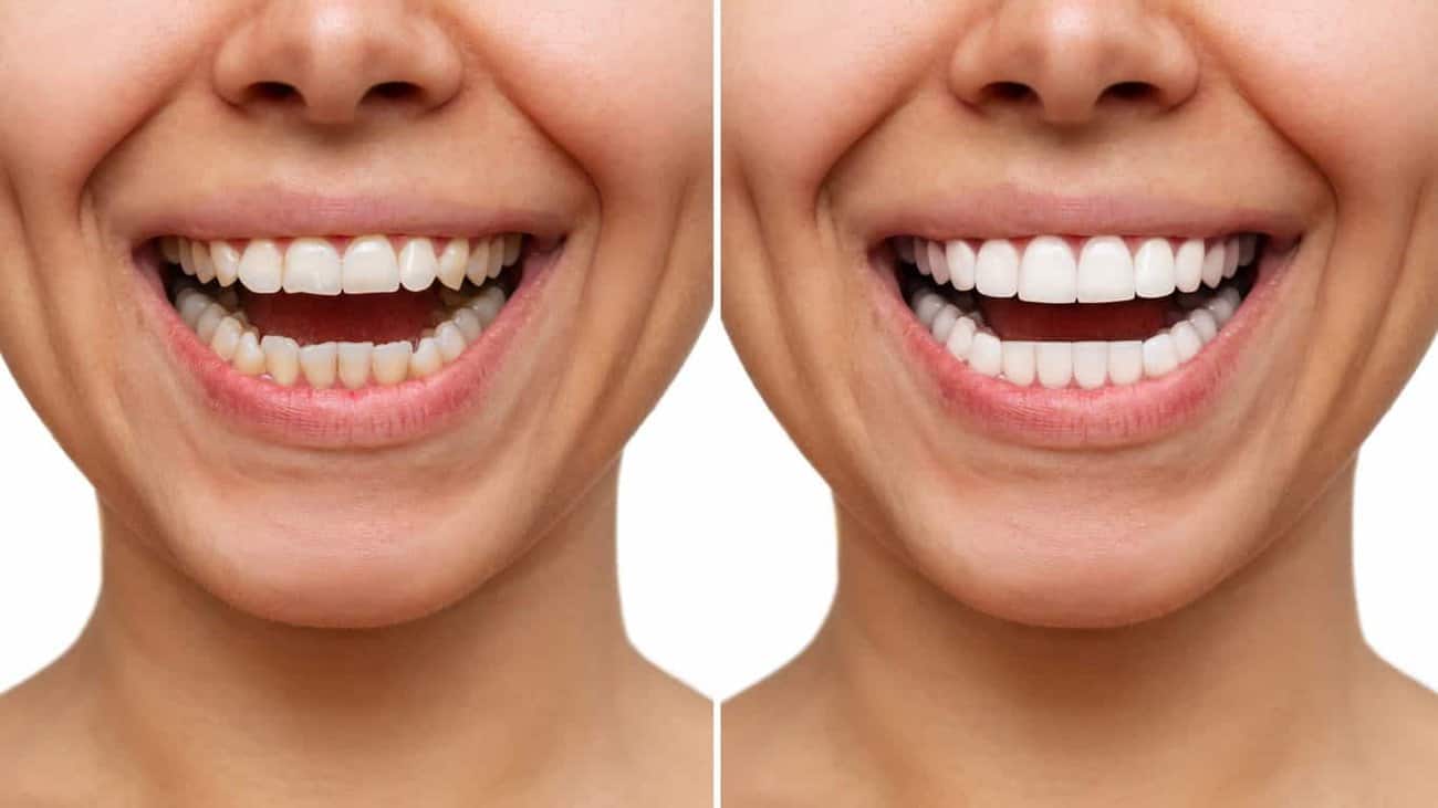 Contact Aspire White for teeth whitening services – Get in touch with Hastings today