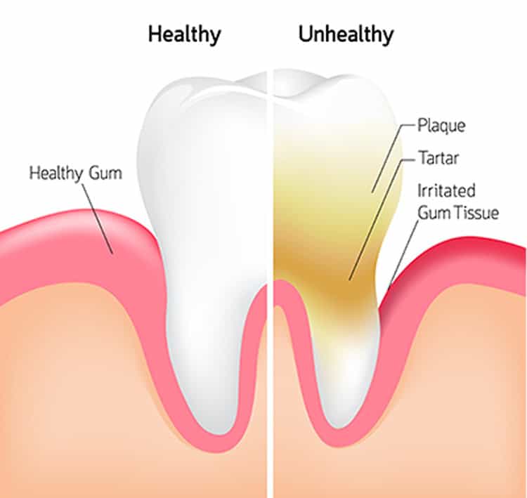 Should you invest in whitening treatments even if your enamel is weak Hastings