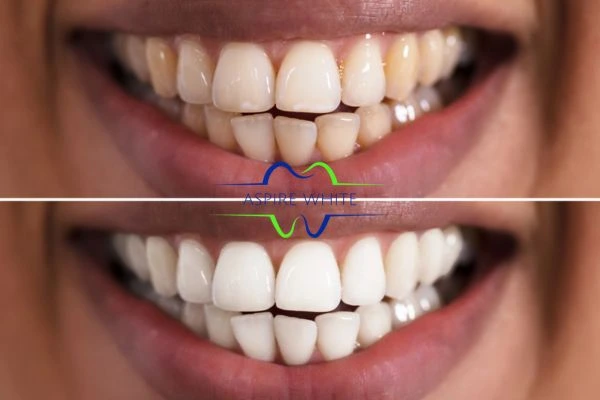 Aspire White customer before and after Hastings results.