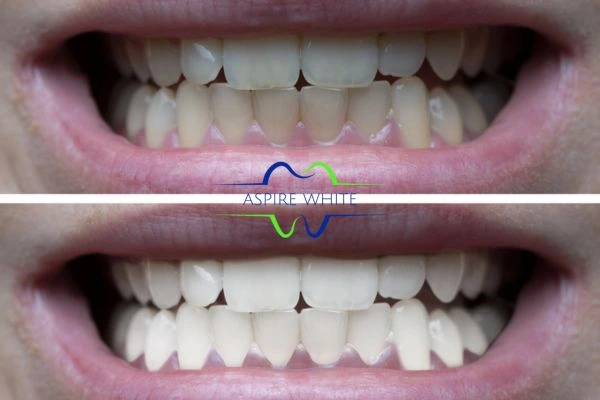 1 hour laser teeth whitening before and after results Hastings