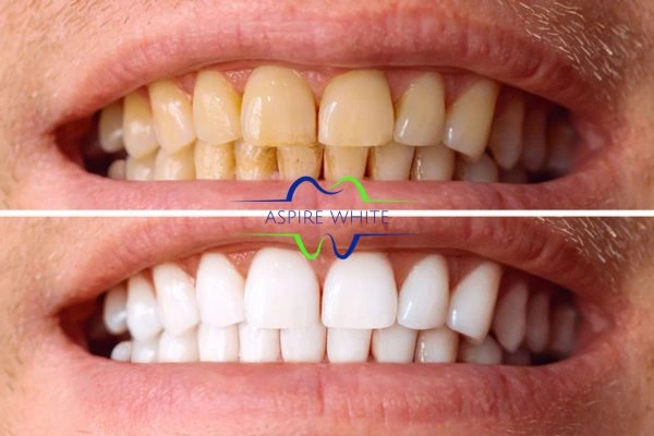 Get noticeable whiter smile in just one hour! Book your teeth whitening treatment Hastings today!