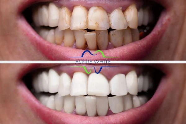 Before and after results of laser teeth whitening Hastings Book in online today!