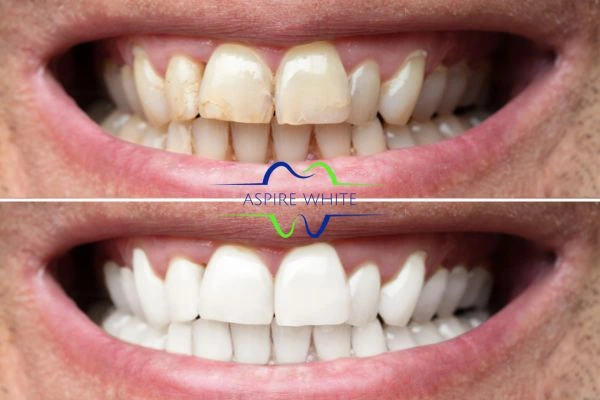 Achieve a radiant smile with professional laser teeth whitening Hastings